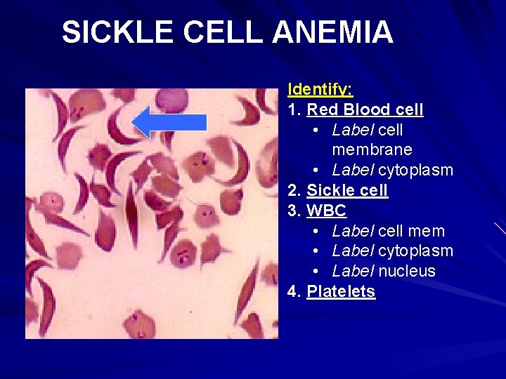 SICKLE CELL ANEMIA Identify: 1. Red Blood cell • Label cell membrane • Label