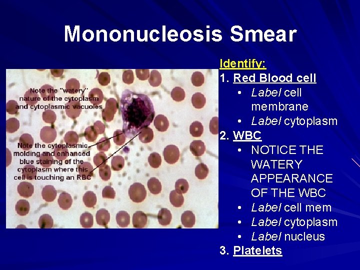 Mononucleosis Smear Identify: 1. Red Blood cell • Label cell membrane • Label cytoplasm