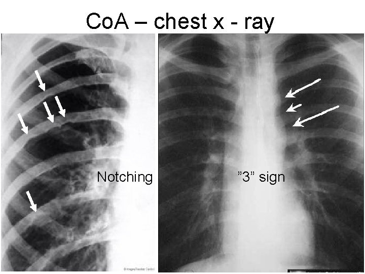 Co. A – chest x - ray Notching ” 3” sign 