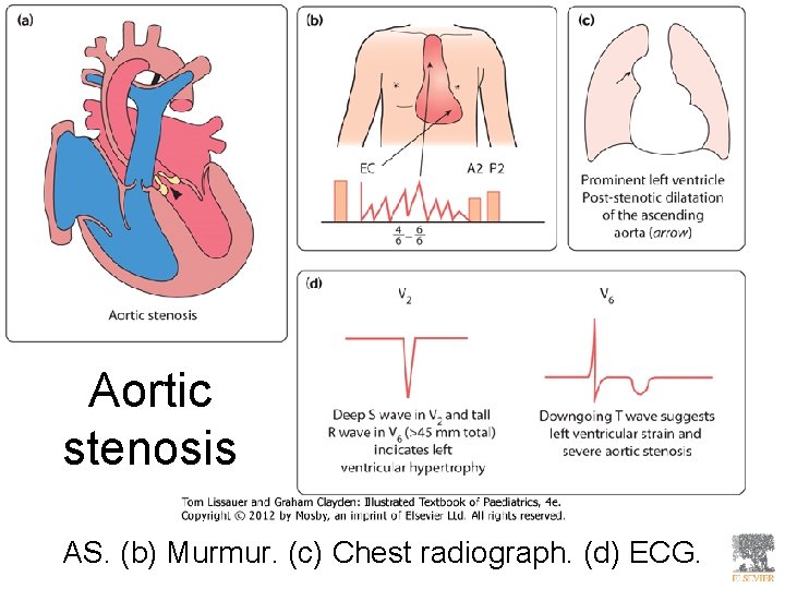 Aortic stenosis AS. (b) Murmur. (c) Chest radiograph. (d) ECG. 
