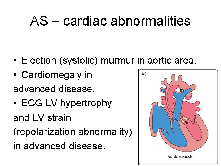 AS – cardiac abnormalities • Ejection (systolic) murmur in aortic area. • Cardiomegaly in