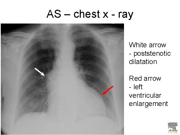 AS – chest x - ray White arrow - poststenotic dilatation Red arrow -