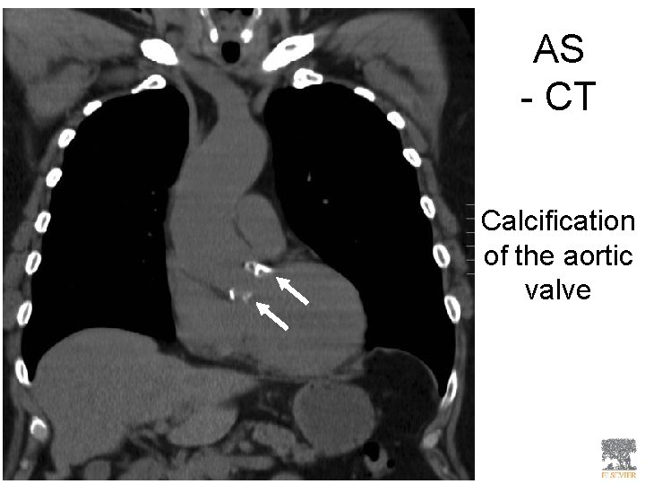 AS - CT Calcification of the aortic valve 