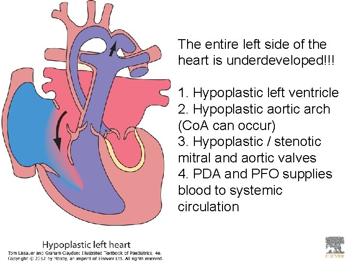 The entire left side of the heart is underdeveloped!!! 1. Hypoplastic left ventricle 2.
