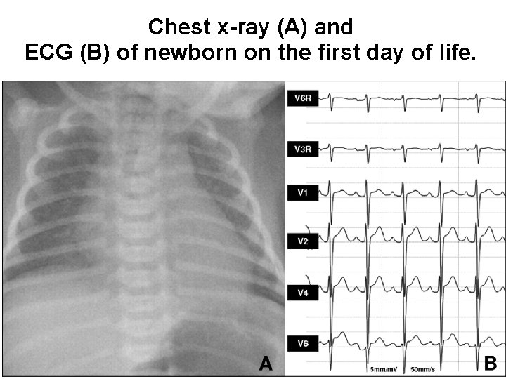 Chest x-ray (A) and ECG (B) of newborn on the first day of life.
