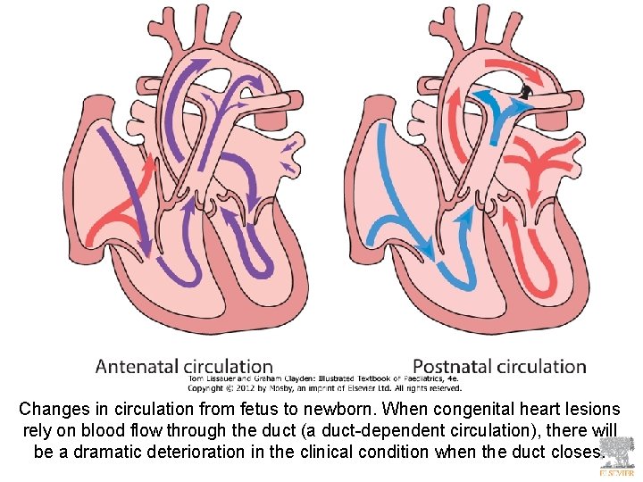 Changes in circulation from fetus to newborn. When congenital heart lesions rely on blood