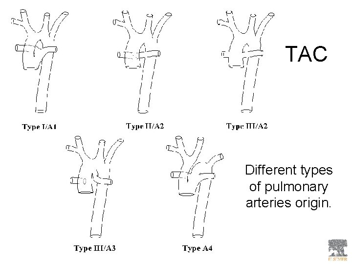 TAC Different types of pulmonary arteries origin. 