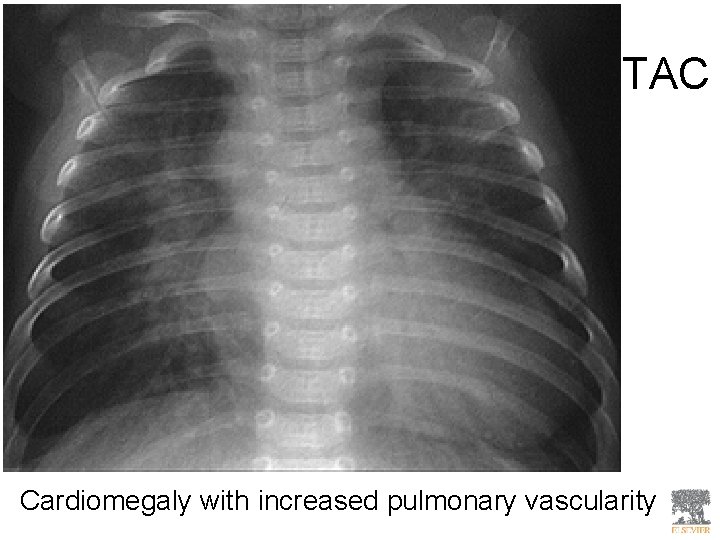 TAC Cardiomegaly with increased pulmonary vascularity 