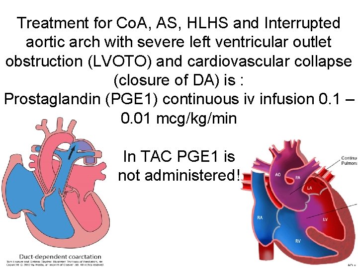 Treatment for Co. A, AS, HLHS and Interrupted aortic arch with severe left ventricular