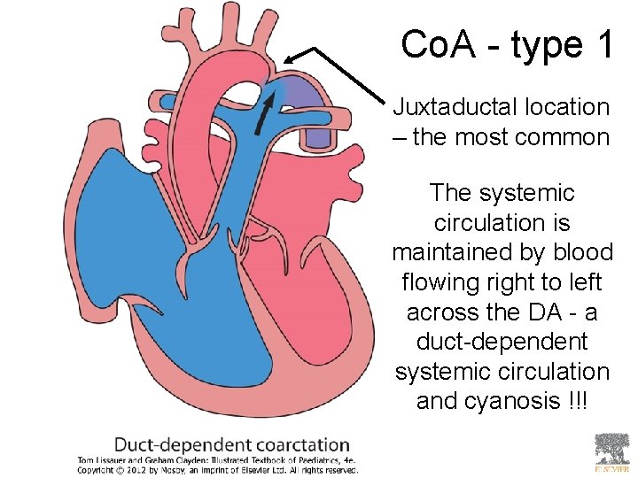 Co. A - type 1 Juxtaductal location – the most common The systemic circulation