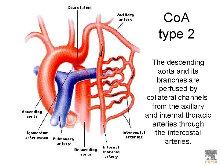 Co. A type 2 The descending aorta and its branches are perfused by collateral