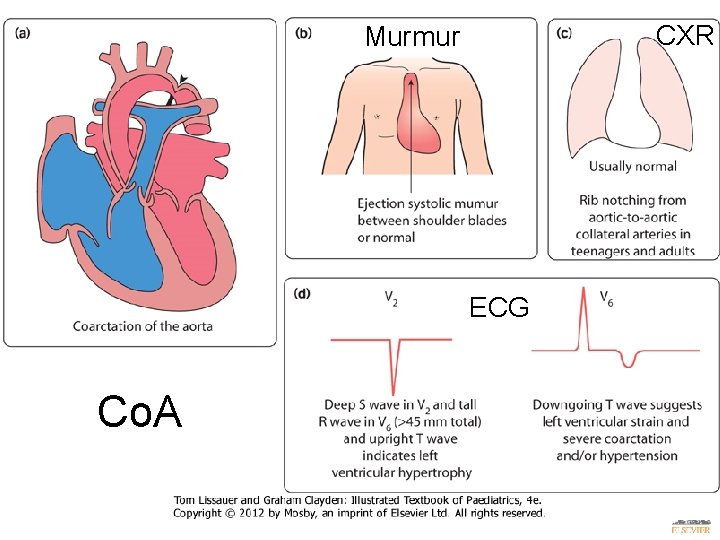 CXR Murmur ECG Co. A 