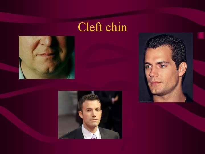 Cleft chin 