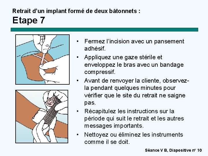 Retrait d’un implant formé de deux bâtonnets : Etape 7 • Fermez l’incision avec