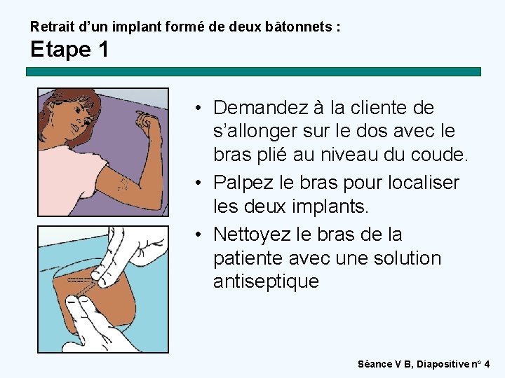 Retrait d’un implant formé de deux bâtonnets : Etape 1 • Demandez à la