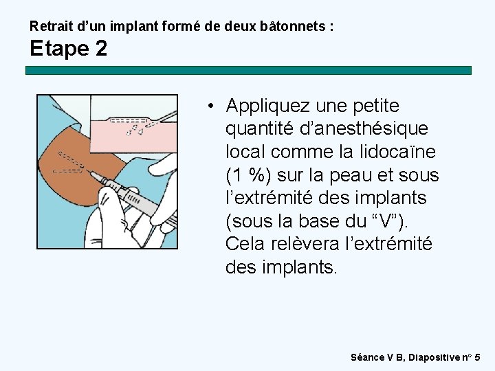 Retrait d’un implant formé de deux bâtonnets : Etape 2 • Appliquez une petite