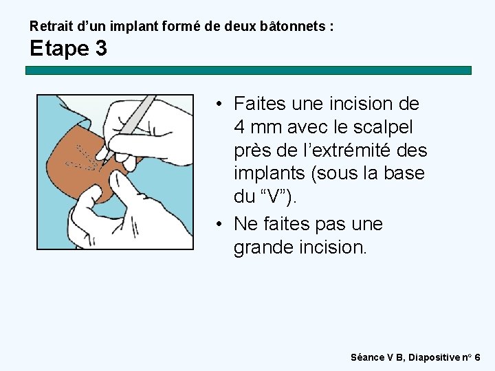 Retrait d’un implant formé de deux bâtonnets : Etape 3 • Faites une incision