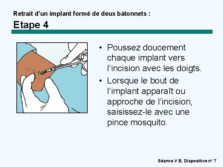 Retrait d’un implant formé de deux bâtonnets : Etape 4 • Poussez doucement chaque