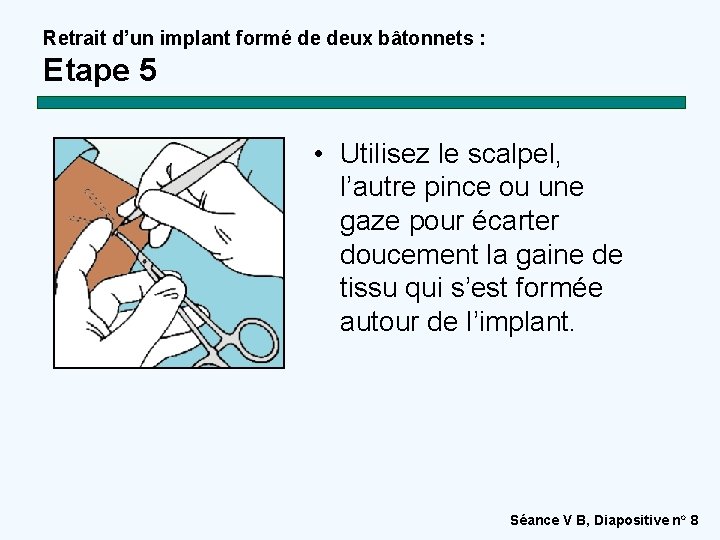 Retrait d’un implant formé de deux bâtonnets : Etape 5 • Utilisez le scalpel,