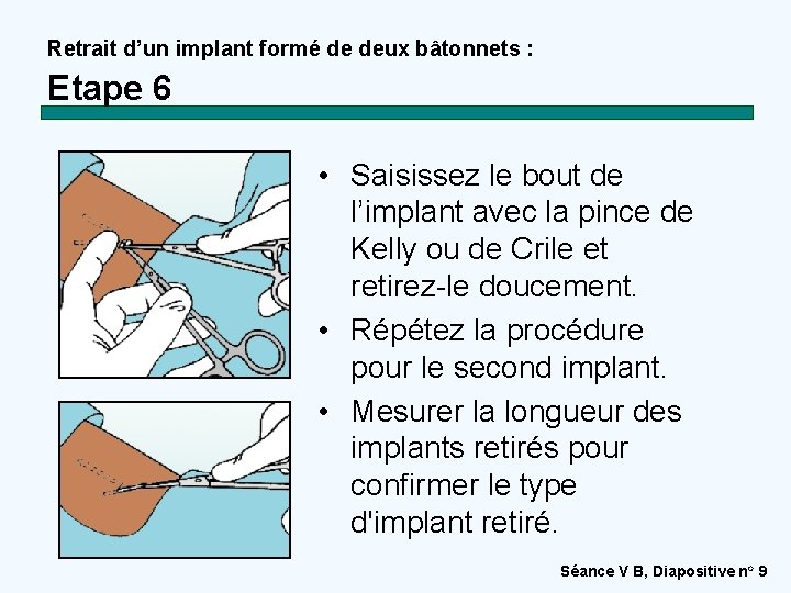 Retrait d’un implant formé de deux bâtonnets : Etape 6 • Saisissez le bout