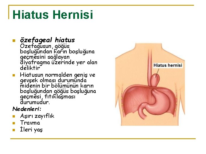 Hiatus Hernisi n özefageal hiatus Özefagusun, göğüs boşluğundan karın boşluğuna geçmesini sağlayan diyafragma üzerinde