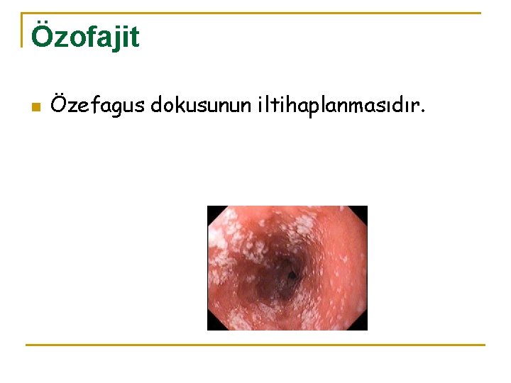 Özofajit n Özefagus dokusunun iltihaplanmasıdır. 