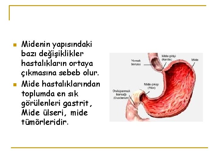 n n Midenin yapısındaki bazı değişiklikler hastalıkların ortaya çıkmasına sebeb olur. Mide hastalıklarından toplumda