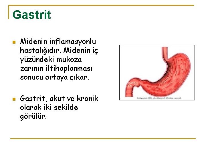 Gastrit n n Midenin inflamasyonlu hastalığıdır. Midenin iç yüzündeki mukoza zarının iltihaplanması sonucu ortaya