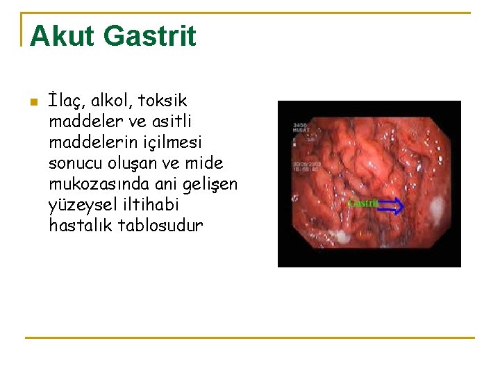 Akut Gastrit n İlaç, alkol, toksik maddeler ve asitli maddelerin içilmesi sonucu oluşan ve