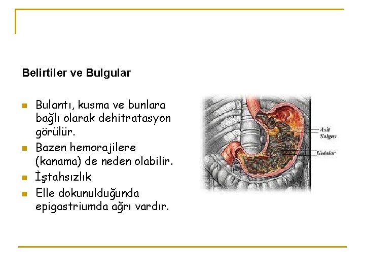 Belirtiler ve Bulgular n n Bulantı, kusma ve bunlara bağlı olarak dehitratasyon görülür. Bazen