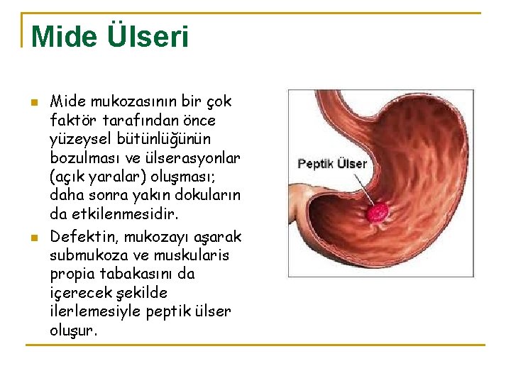 Mide Ülseri n n Mide mukozasının bir çok faktör tarafından önce yüzeysel bütünlüğünün bozulması