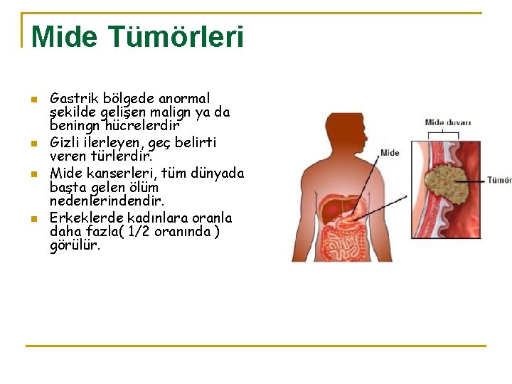 Mide Tümörleri n n Gastrik bölgede anormal şekilde gelişen malign ya da beningn hücrelerdir