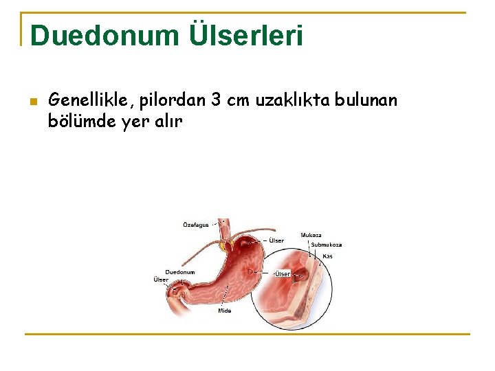 Duedonum Ülserleri n Genellikle, pilordan 3 cm uzaklıkta bulunan bölümde yer alır 