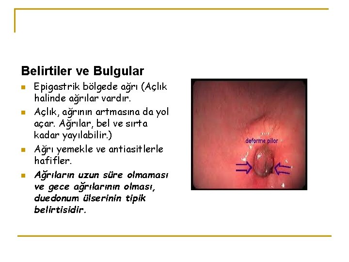 Belirtiler ve Bulgular n n Epigastrik bölgede ağrı (Açlık halinde ağrılar vardır. Açlık, ağrının