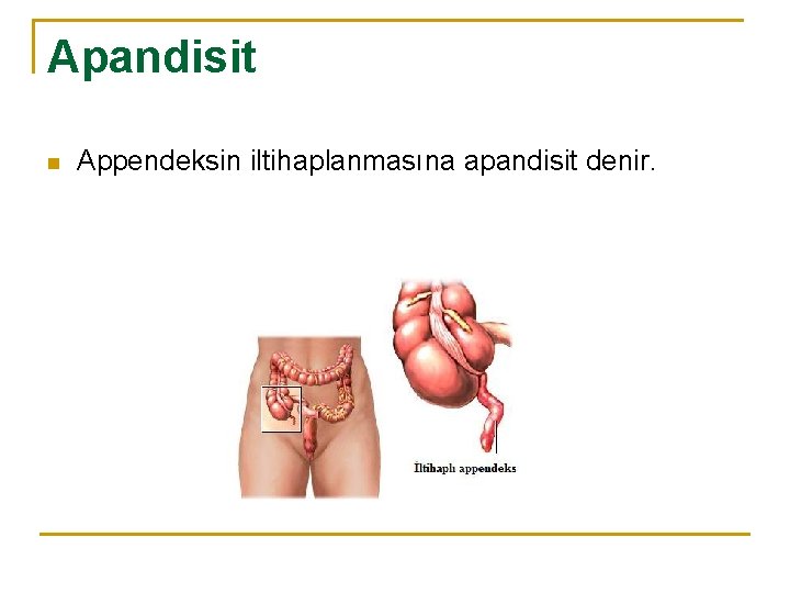 Apandisit n Appendeksin iltihaplanmasına apandisit denir. 