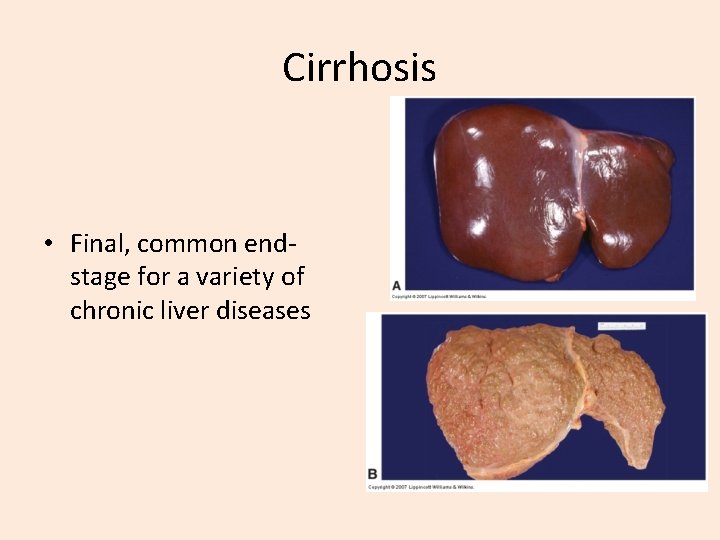 Cirrhosis • Final, common endstage for a variety of chronic liver diseases 