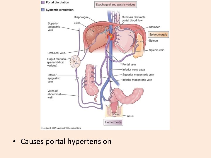  • Causes portal hypertension 