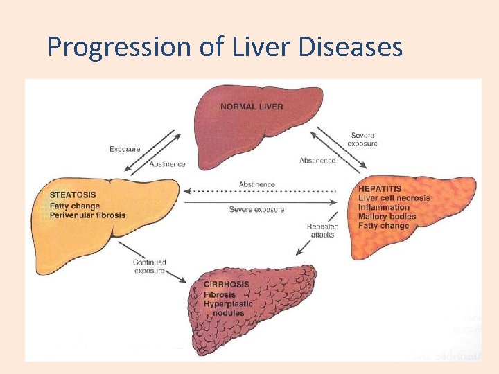 Progression of Liver Diseases 