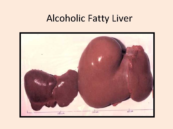 Alcoholic Fatty Liver 