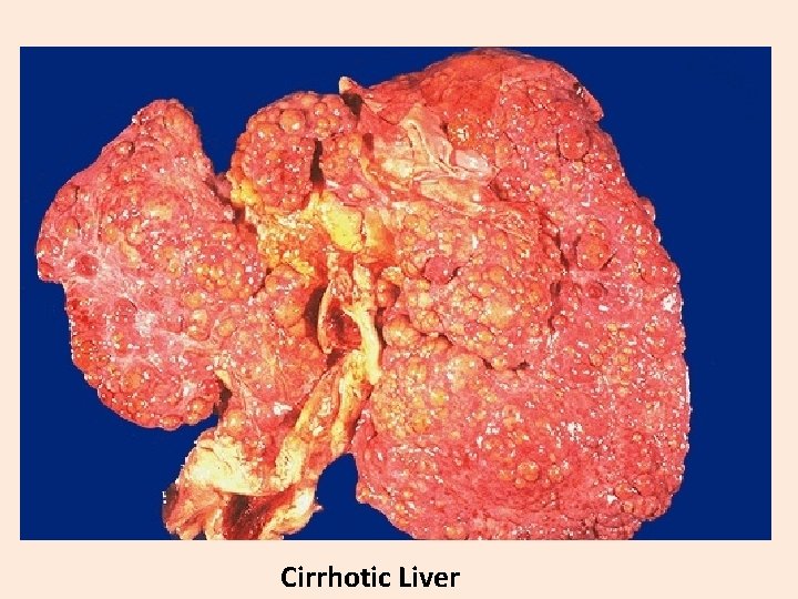 Cirrhotic Liver 