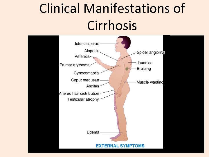 Clinical Manifestations of Cirrhosis 