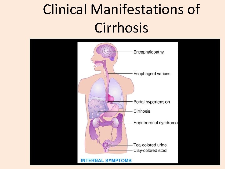 Clinical Manifestations of Cirrhosis 