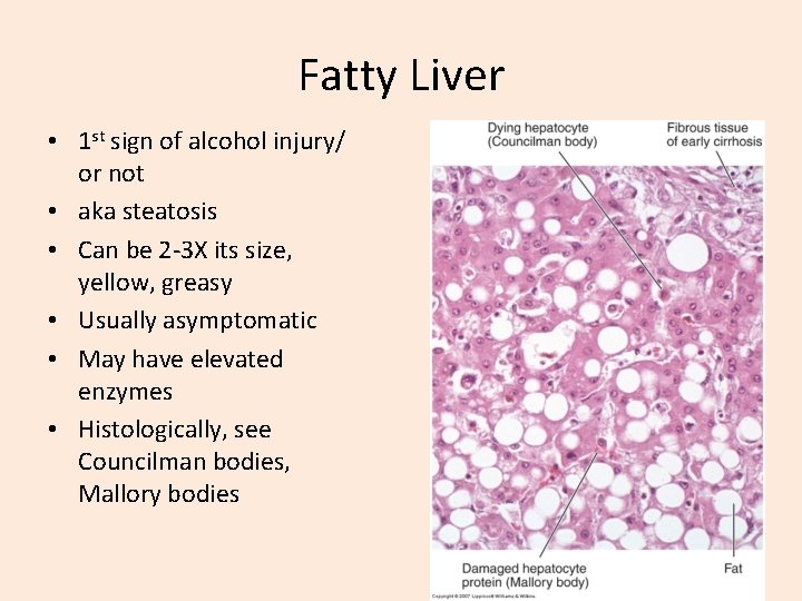 Fatty Liver • 1 st sign of alcohol injury/ or not • aka steatosis