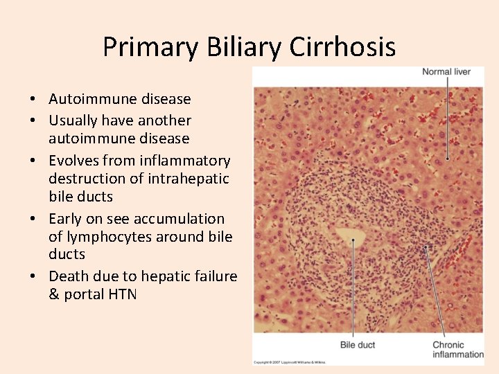 Primary Biliary Cirrhosis • Autoimmune disease • Usually have another autoimmune disease • Evolves