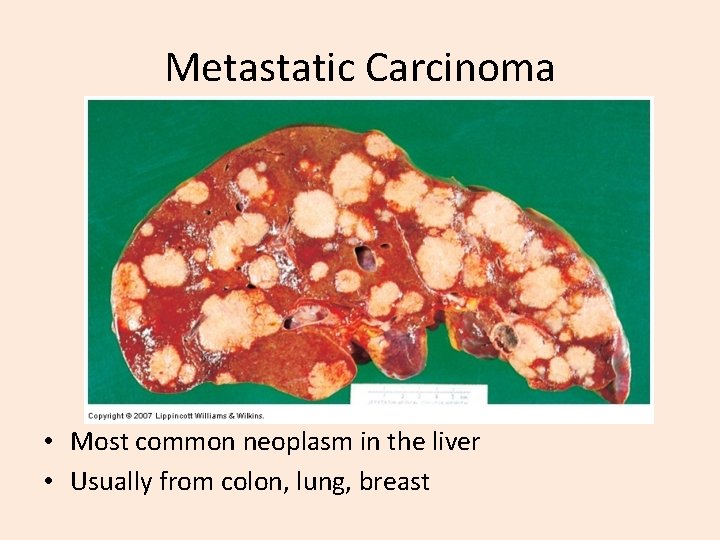 Metastatic Carcinoma • Most common neoplasm in the liver • Usually from colon, lung,