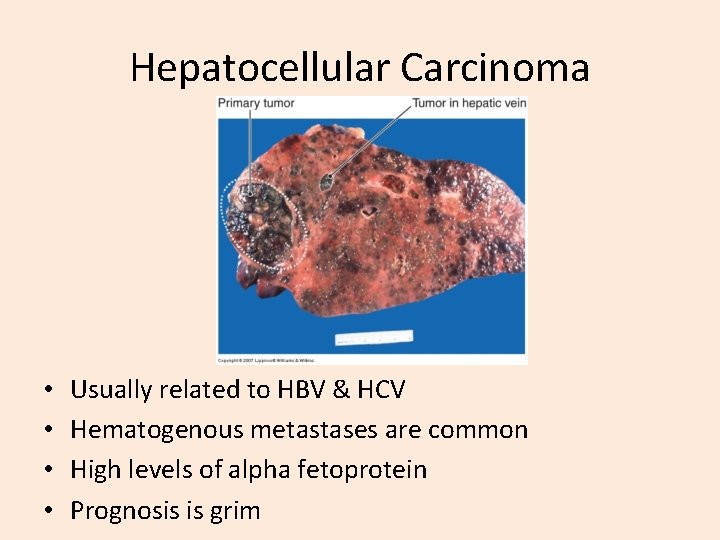 Hepatocellular Carcinoma • • Usually related to HBV & HCV Hematogenous metastases are common