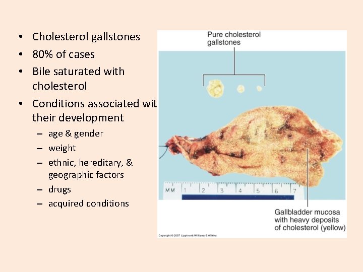  • Cholesterol gallstones • 80% of cases • Bile saturated with cholesterol •