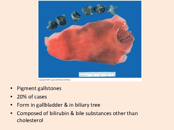  • • Pigment gallstones 20% of cases Form in gallbladder & in biliary