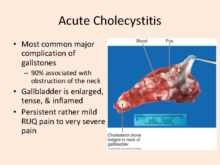 Acute Cholecystitis • Most common major complication of gallstones – 90% associated with obstruction