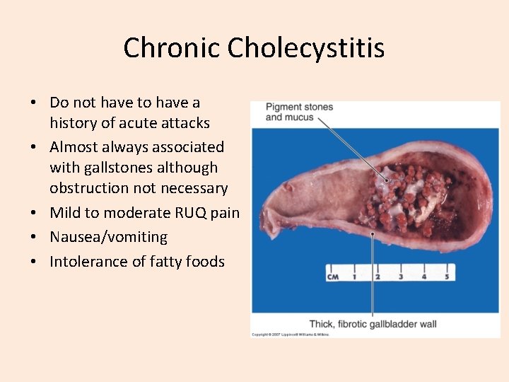 Chronic Cholecystitis • Do not have to have a history of acute attacks •